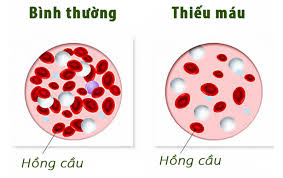 Bài thuốc Trị thiếu máu