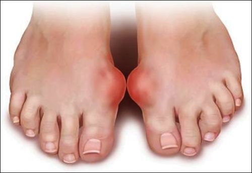 Biểu hiện đặc trưng của bệnh Gout