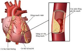 Món ăn chữa bệnh động mạch vành
